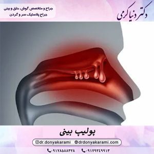 پولیپ بینی | دکتر دنیا کرمی