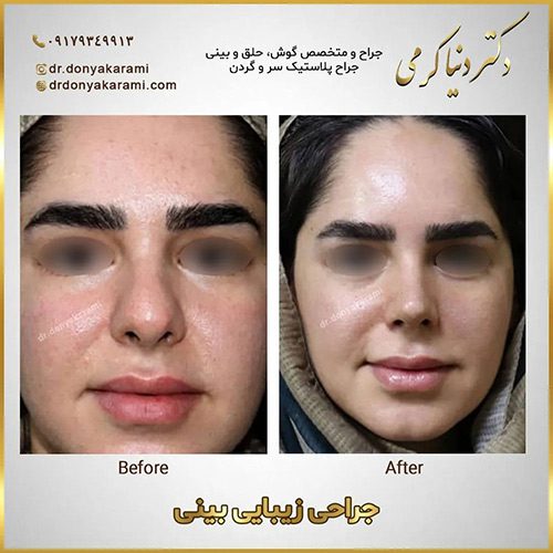 جراحی بینی گوشتی در شیراز | دکتر دنیا کرمی