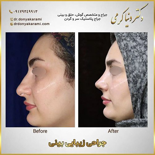 جراحی بینی گوشتی در شیراز | دکتر دنیا کرمی