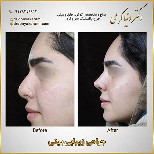 جراحی بینی گوشتی در شیراز | دکتر دنیا کرمی