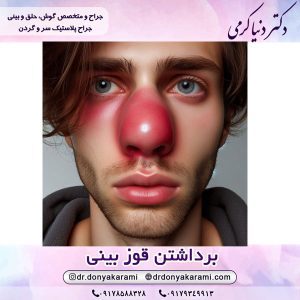 کبودی بعد از عمل بینی- دکتر دنیا کرمی