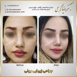 نمونه کار بهترین جراح بینی در شیراز | دکتر دنیا کرمی