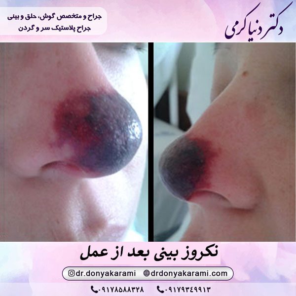 نکروز بینی بعد از عمل