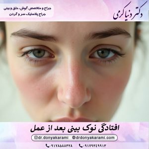 افتادگی نوک بینی بعد از عمل - دکتر دنیا کرمی