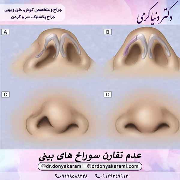عدم تقارن سوراخ های بینی بعد عمل