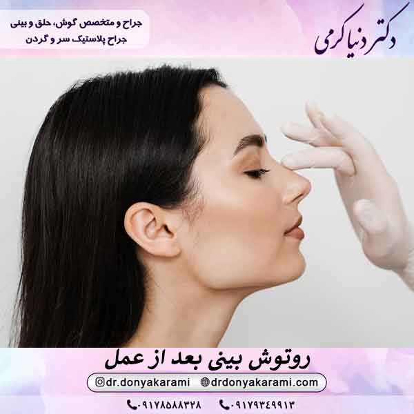 روتوش بینی بعد از عمل
