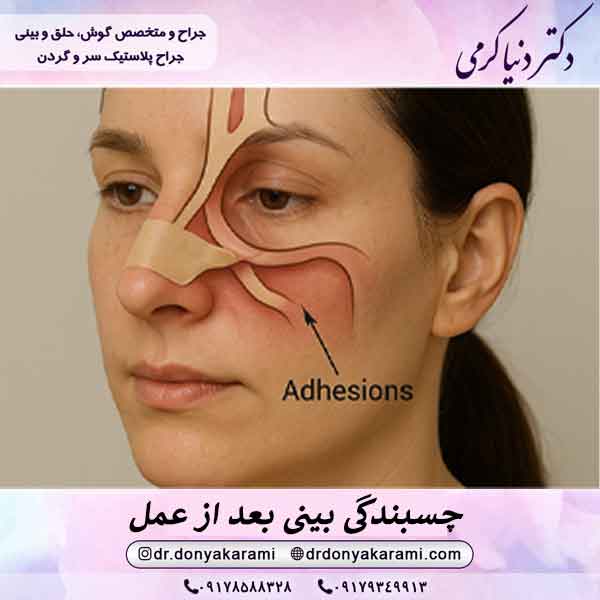 چسبندگی بینی بعد از عمل