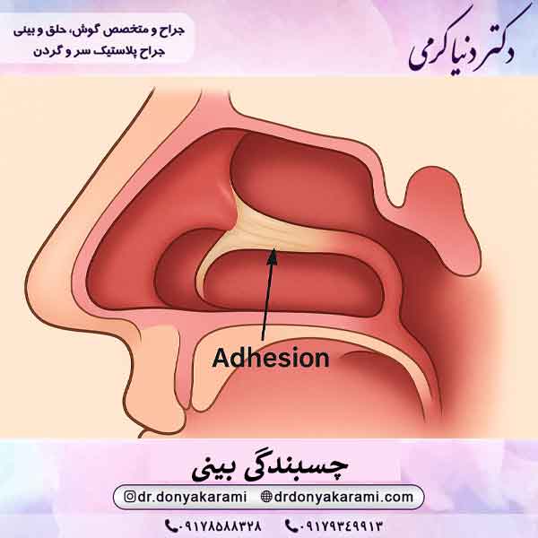 چسبندگی بینی