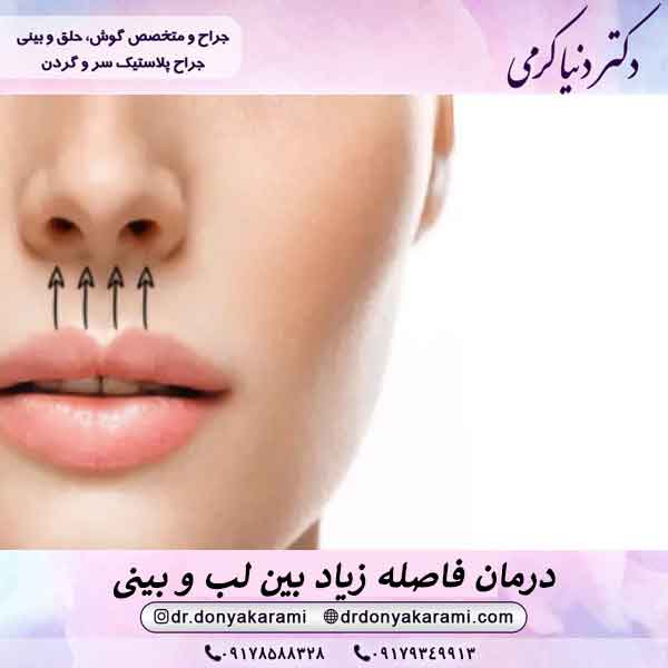 درمان فاصله زیاد بین لب و بینی