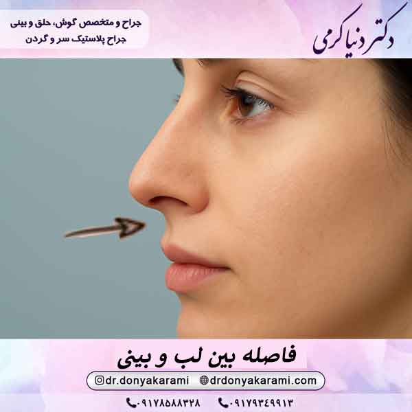 فاصله زیاد لب و بینی بعد از عمل