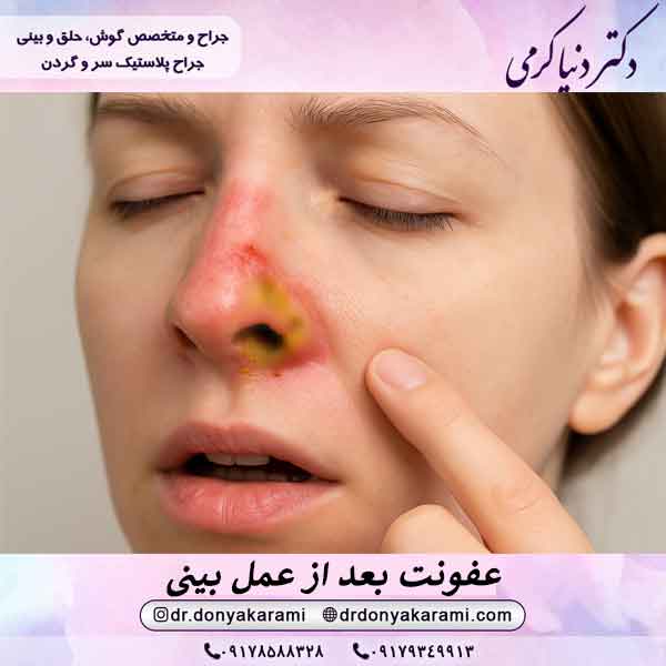 عفونت بعد از عمل بینی