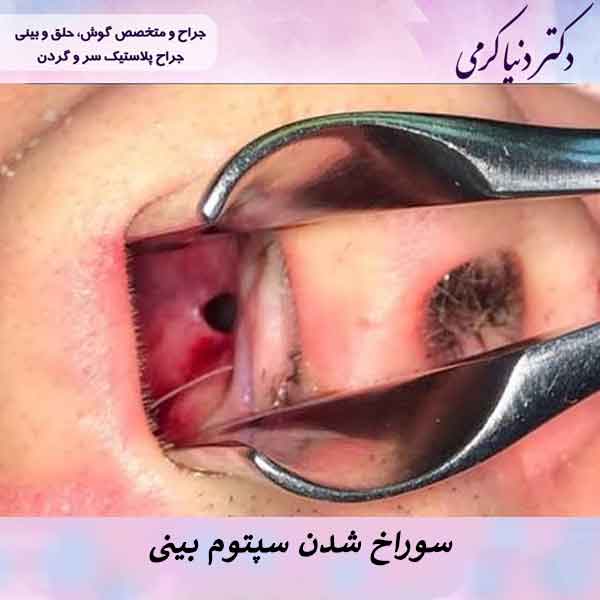 سوراخ شدن سپتوم بینی