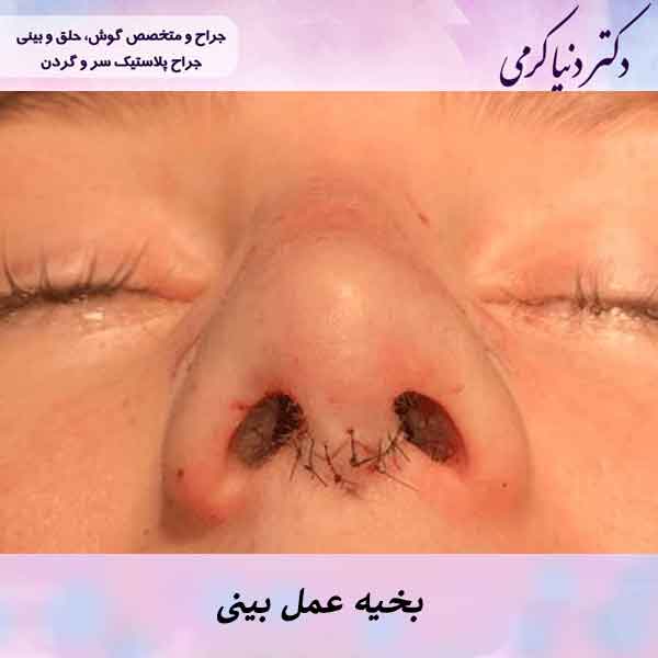 همه چیز درباره بخیه عمل بینی که لازم است بدانید.