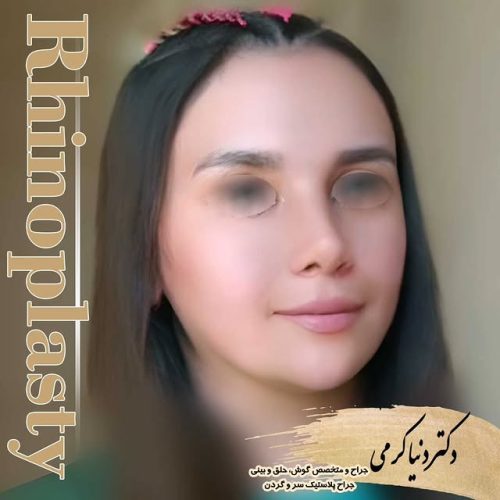 rhinoplasty-186