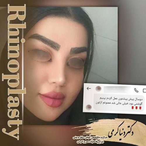 rhinoplasty-188
