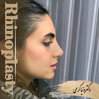 rhinoplasty-194