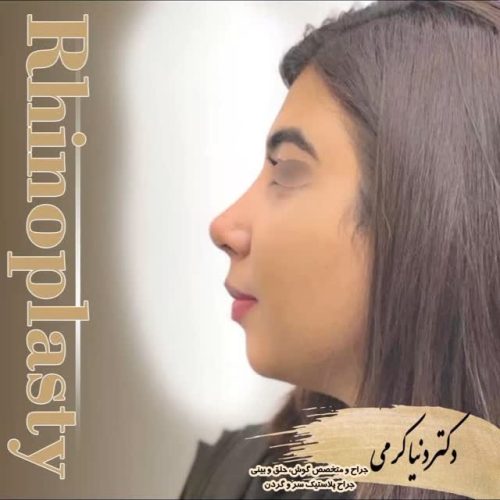 rhinoplasty-195