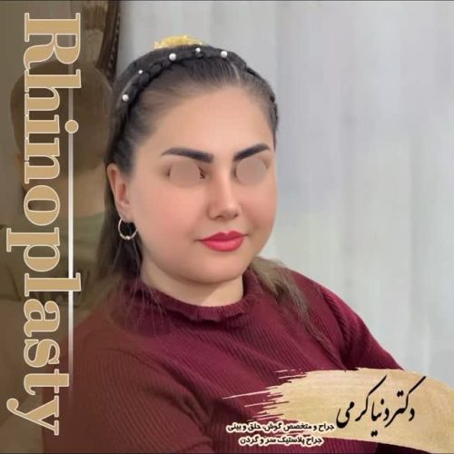 rhinoplasty-198