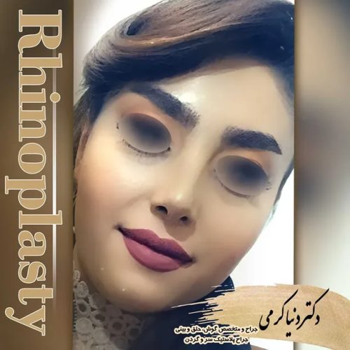 rhinoplasty-199