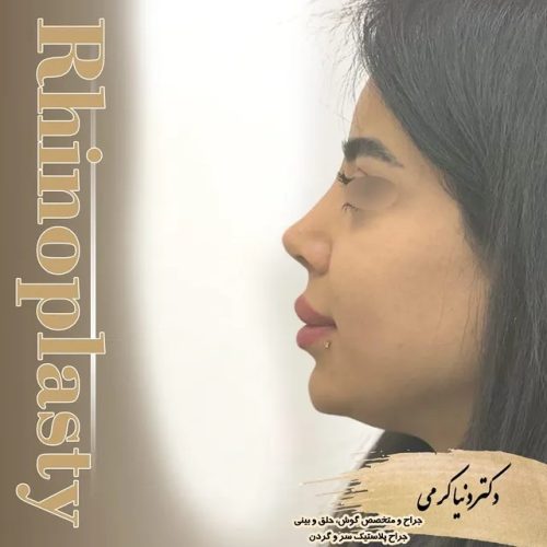 rhinoplasty-200