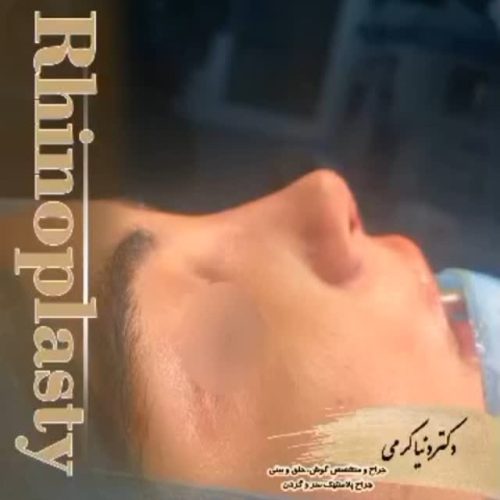 rhinoplasty-201