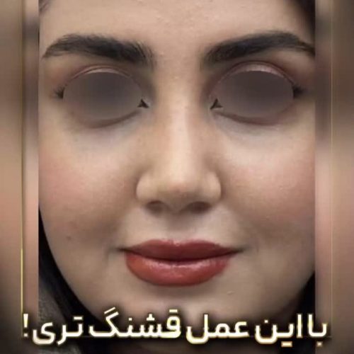 rhinoplasty-203