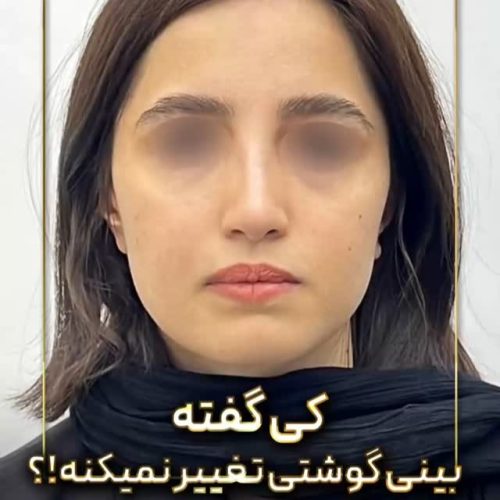 rhinoplasty-204