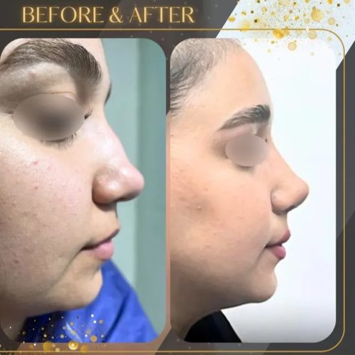 rhinoplasty-205