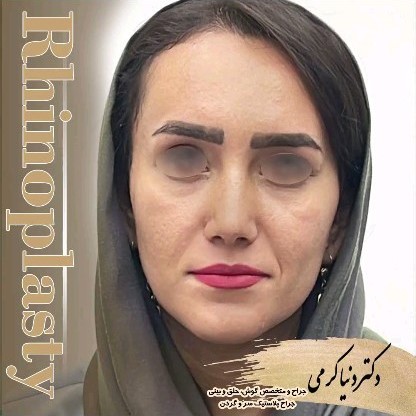rhinoplasty-206