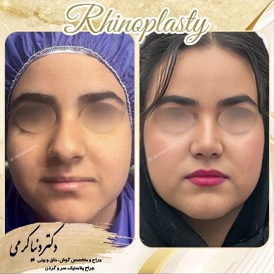 rhinoplasty-207
