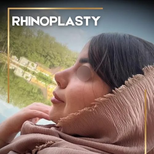 rhinoplasty-212