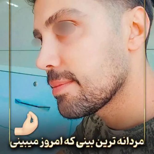 rhinoplasty-214