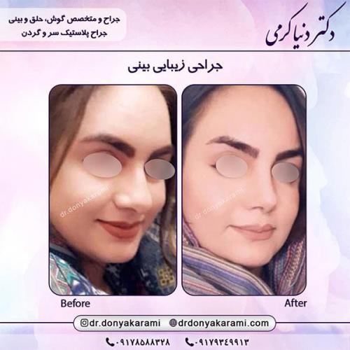 جراحی-بینی-1