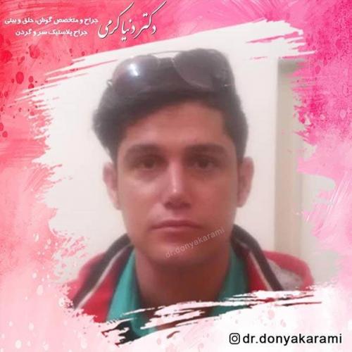 جراحی-بینی-12