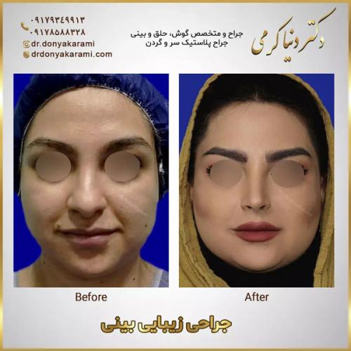 جراحی-بینی-134