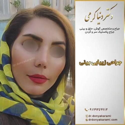 جراحی-بینی-137