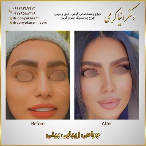 جراحی-بینی-139