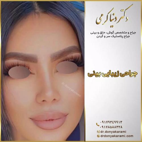 جراحی-بینی-140