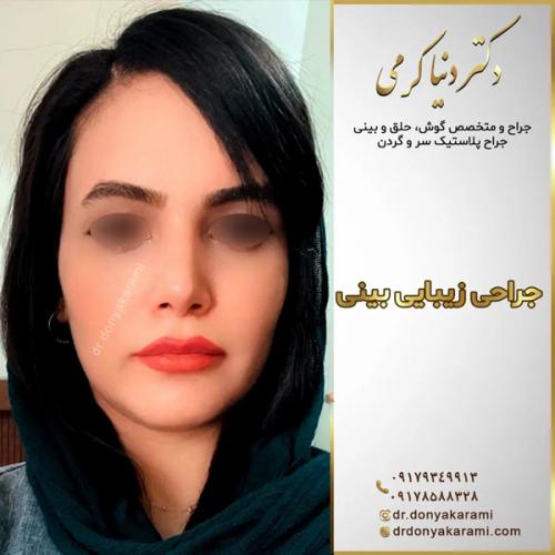 جراحی-بینی-141