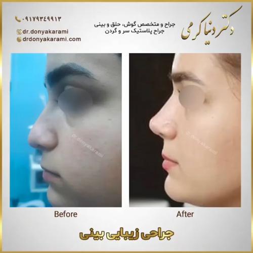 جراحی-بینی-143