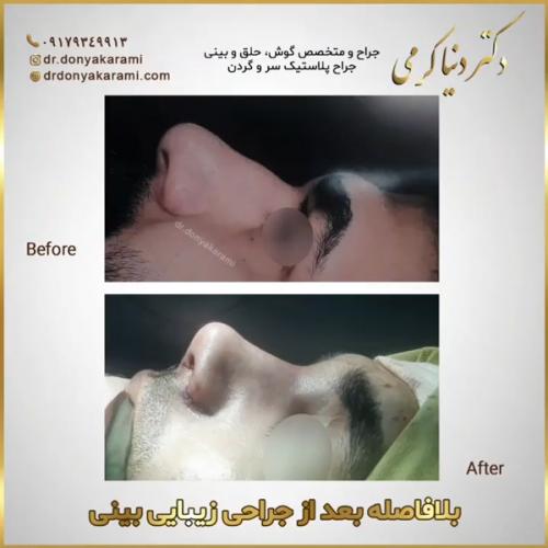 جراحی-بینی-153