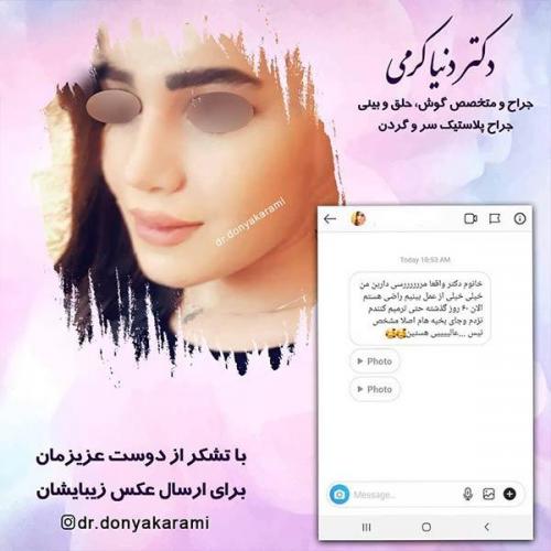 جراحی-بینی-17