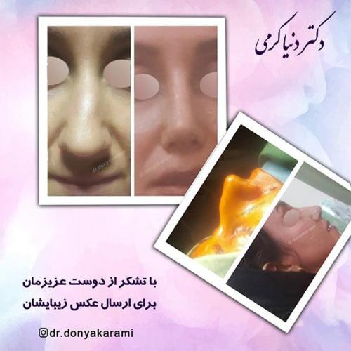 جراحی-بینی-2