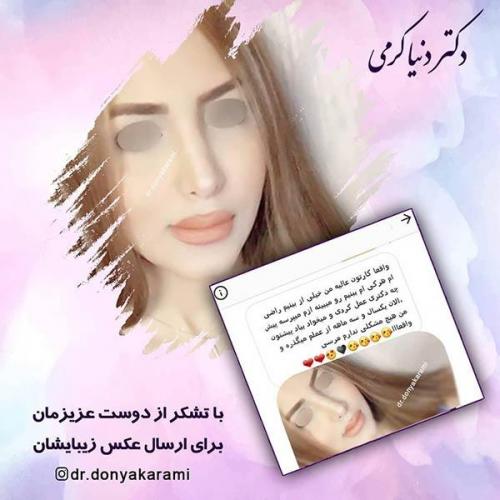 جراحی-بینی-20