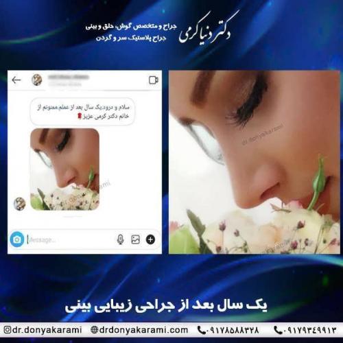 جراحی-بینی-22