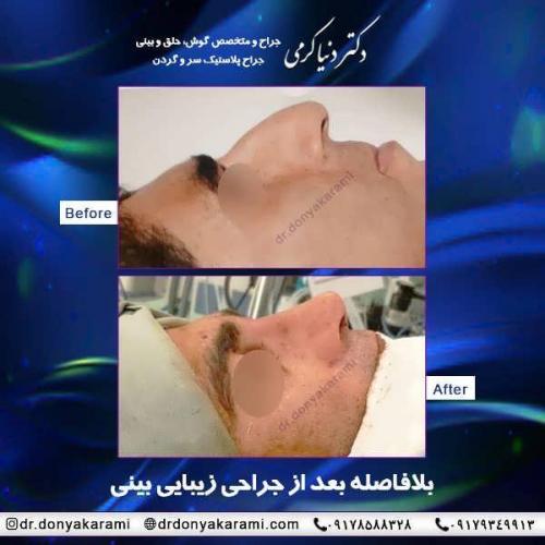 جراحی-بینی-23