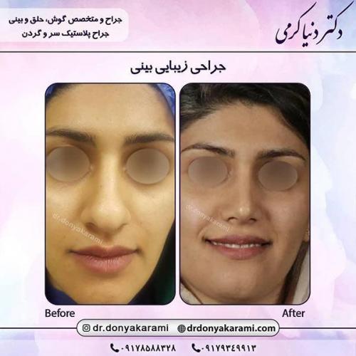 جراحی-بینی-3