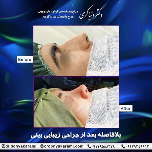جراحی-بینی-37