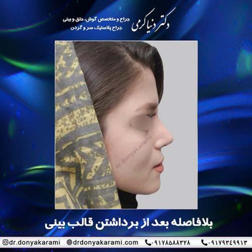 جراحی-بینی-39