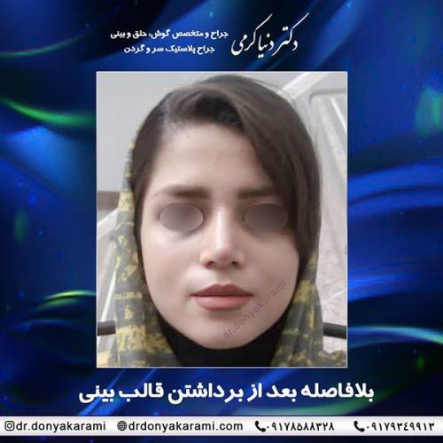 جراحی-بینی-40